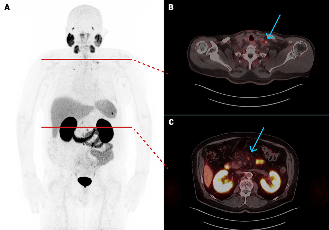 Figur 2 [⁶⁸Ga]PSMA-11 PET/CT etter fem behandlinger med [&sup1;⁷⁷Lu]PSMA-617 viste betydelig st&oslash;rrelsesreduksjon av metastatiske&hellip;