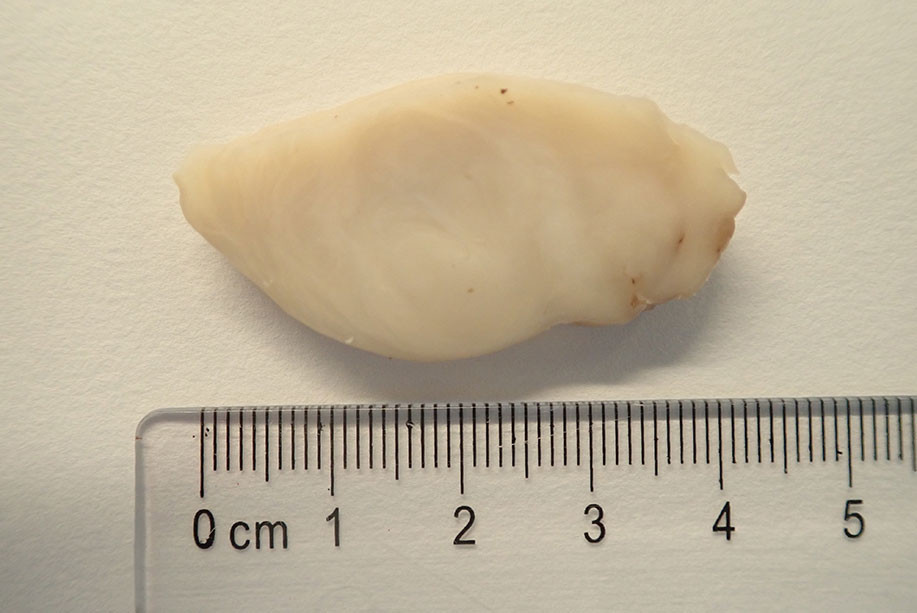 Figure 1 Well-defined tumour tissue with greyish white cross-sectional surface