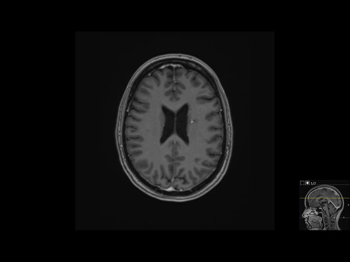 Figure 3 Brain MRI. Four-year check-up after gamma knife radiosurgery.