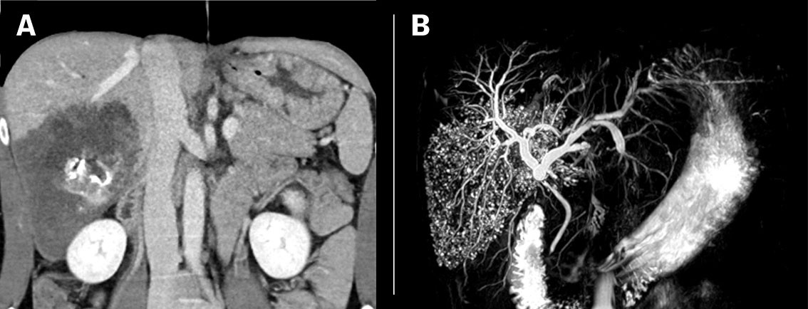 Figure 1 a) Patient with alveolar echinococcosis (patient 1). CT with contrast in venous phase with coronal reconstruction&hellip;