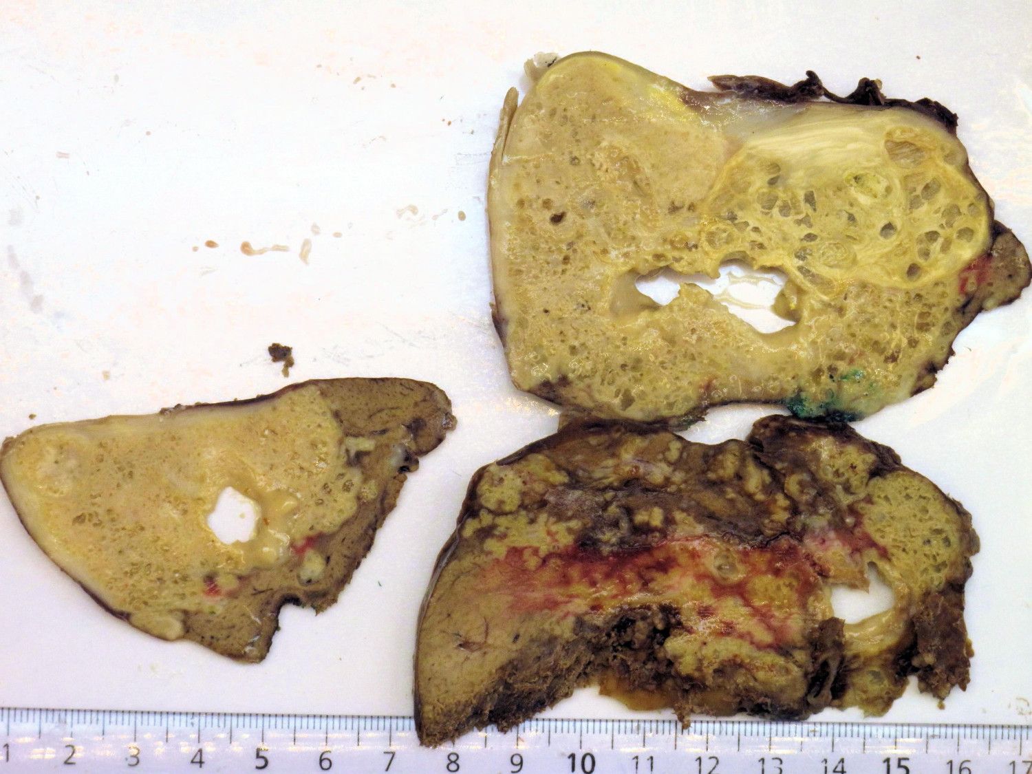 Figure 2 Surgical specimen shows multicystic tumour in liver segments 6 and 7 (patient 1).