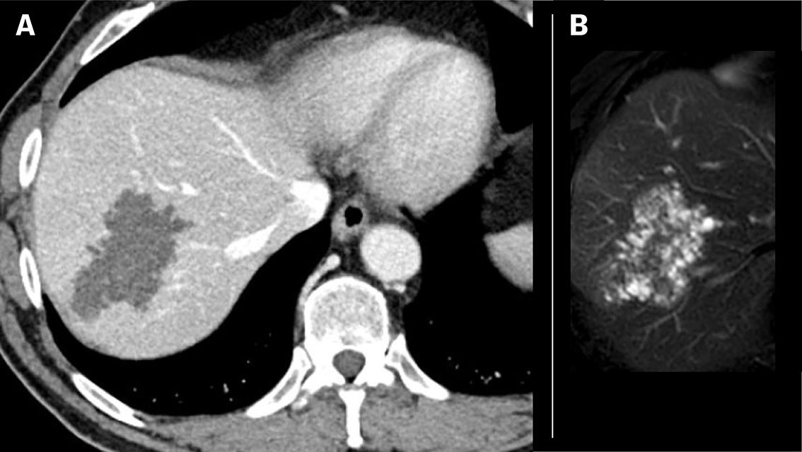 Figure 3 Patient with alveolar echinococcosis (patient 2). a) CT with contrast shows a well-defined, low attenuation lesion&hellip;