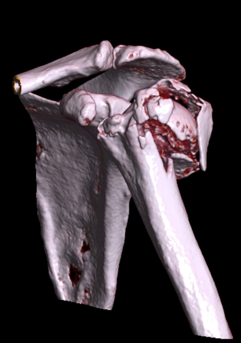 Figur 2 Pasient i 60-&aring;rene med 4-parts dislokert proksimal humerusfraktur etter fall fra egen h&oslash;yde. Kompleksiteten i&hellip;
