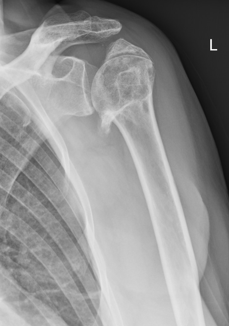 Figur 3 Samme pasient som i figur 2, n&aring; ved 12-m&aring;neders kontroll. Caputfragmentet er tilhelet i en bedre posisjon, men&hellip;