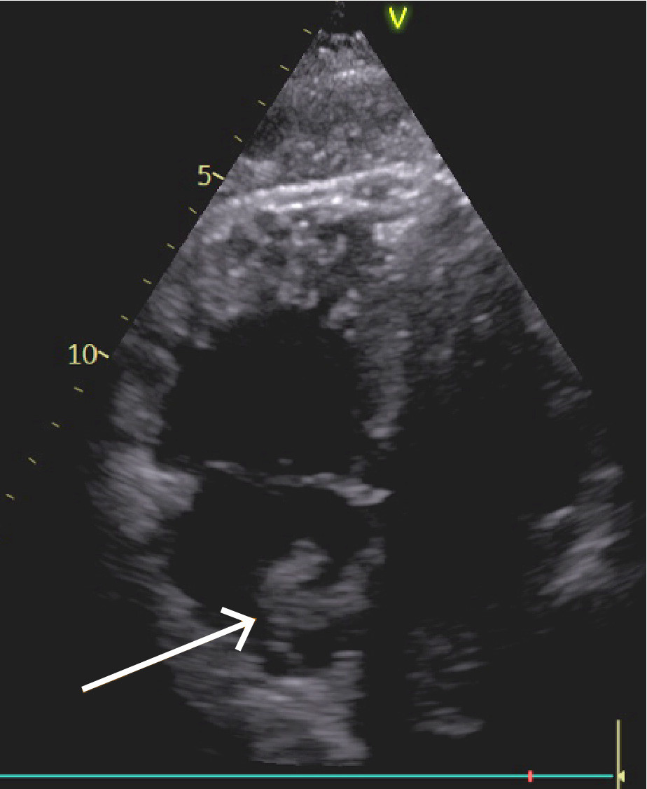 Figur 3 Ekkokardiografi. H&oslash;yre ventrikkel oppe til venstre, h&oslash;yre atrium nede til venstre. Flagrende masse i h&oslash;yre atrium &hellip;