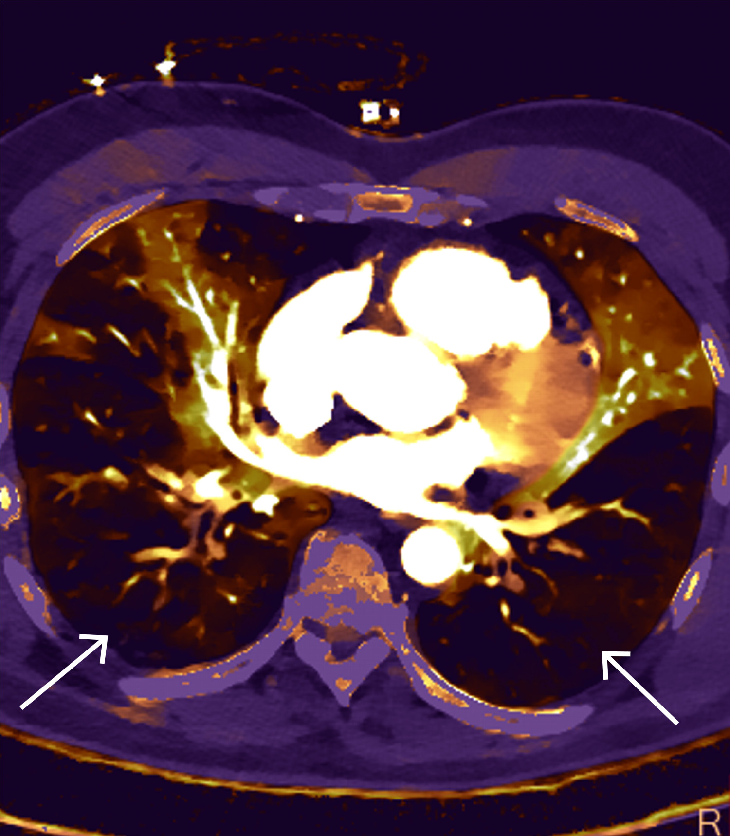 Figur 5 P&aring; spektral-CT kan man gj&oslash;re rekonstruksjoner som viser jodtetthet. Dette gir et kart som viser b&aring;de bortfall av og&hellip;