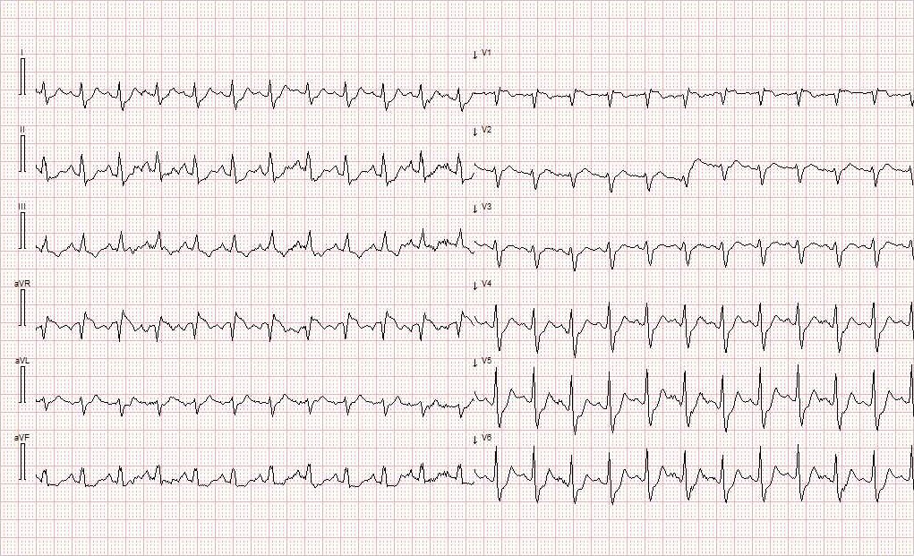 Figur 1 F&oslash;rste prehospitale EKG viser sinustakykardi 143/min, &oslash;kt amplitude av P-b&oslash;lgen i avledningene II og III, subtil ST&hellip;