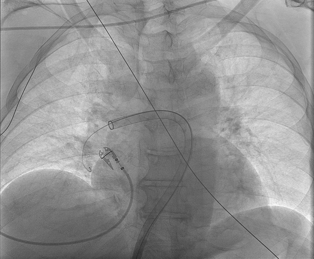 Figur 6 R&oslash;ntgengjennomlysning som viser kateterplassering i arteria pulmonalis.