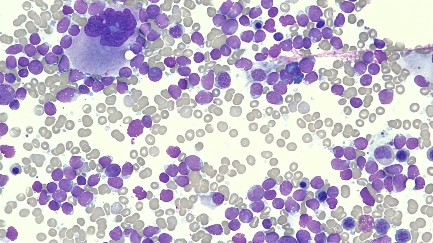 Figur 1 Beinmergsutstryk 400&times; forst&oslash;rring. Beinmergen er dominert av mellomstore, monotone celler med liten cytoplasma:&hellip;