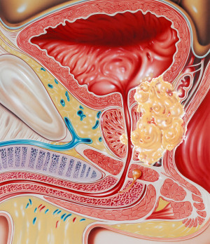 Prostatakreft. Fremstilling av en forst&oslash;rret prostatakjertel som har invadert bl&aelig;reveggen (over) og rektalveggen (til h&oslash;yre)&hellip;
