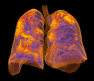 3D-CT av lunger preget av atypisk covid-19-pneumoni (ujevne gule og r&oslash;de omr&aring;der). Illustrasjonsfoto: Science Photo Library &hellip;