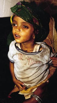  Figur 5    Eneste overlevende barn av seks med empyem, reddet av antibiotika og drenasje ved Jibla Baptist Hospital (Jemen&hellip;