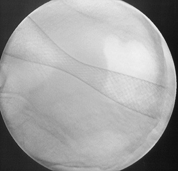 Figur 1  b) Kontrollbilde ved hjelp av gjennomlysning etter utfolding av stent. Foto Stavanger universitetssjukehus