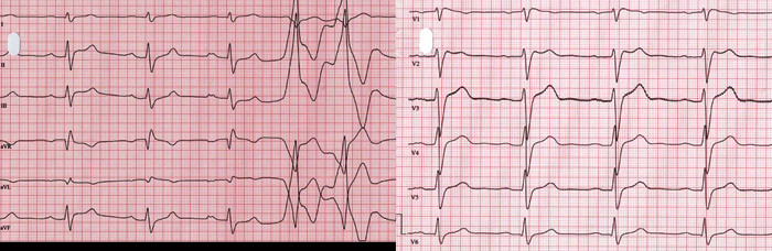 Figure 2  ECG (50mm/s) recorded during the most recent examination of the patient. The pattern corresponds to type 2-ECG in&hellip;