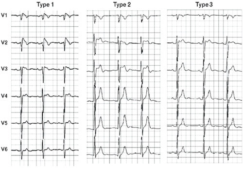 Figure 3  Examples (25mm/s) of the three different ECG morphology types typical of the Brugada syndrome (4)