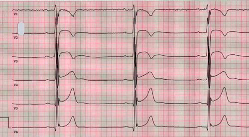 Figure 4  ECG (50mm/s) with precordial leads recorded from an athlete specialising in long-distance running