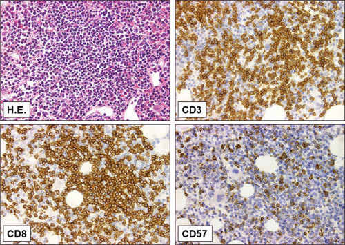 Figure 3  Trephine biopsy from a patient with LGL-leukaemia with extensive bone marrow affection. A specimen stained with&hellip;