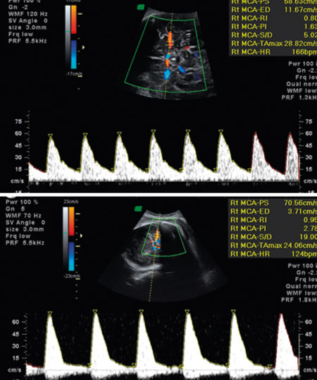Figur 3  Dopplerunders&oslash;kelse av blodstr&oslash;mshastighet i a. cerebri media ved uke 32 fra normalt foster (&oslash;verst) og anemisk&hellip;