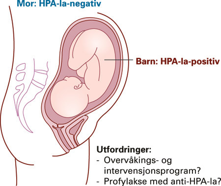 Figur 4  HPA-1a-negativ mor kan immuniseres mot antigenet HPA-1a p&aring; fosterets trombocytter