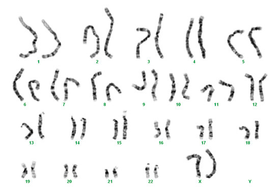 Figur 1  G-b&aring;nd-karyotyping (trypsinbehandlede og Giemsa-fargede metafasekromosomer) hos en normal kvinne med karyotype 46,XX