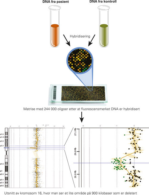 Figur 4  Ved matrisebasert komparativ genomhybridisering (aCGH) renses DNA fra en blod- eller vevspr&oslash;ve, og etter oppkutting&hellip;