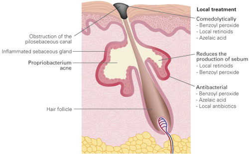 Figure 1  The anatomy of the sebaceous gland and points of attack for various drugs for local treatment