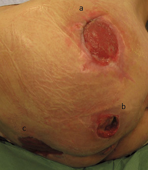 Figure 1  Paraplegic patient who has developed an approximately 10 cm grade 3 pressure ulcer, over the greater trochanter (a&hellip;