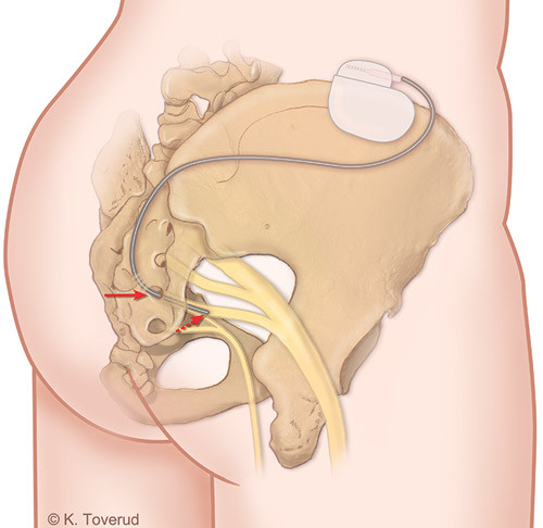 Figure 1:  Schematic drawing of a woman&rsquo;s sacrum and pelvis, posterior view. The nerve electrode has been inserted through&hellip;