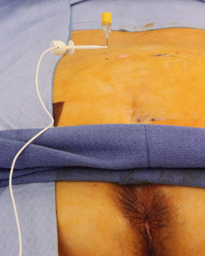 Figure 3:  A cannula has been placed in the third sacral foramen on the left side. The cannula is attached to an electrical&hellip;