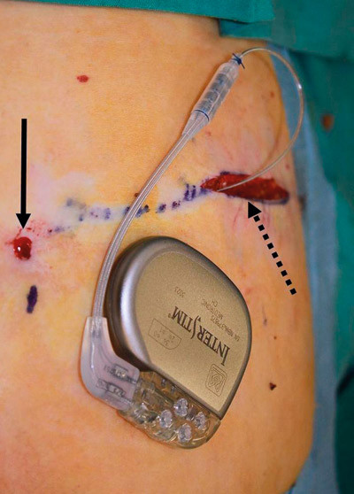 Figure 4:  A permanent stimulator attached to an electrode which has been tunnelled subcutaneously from the third sacral&hellip;