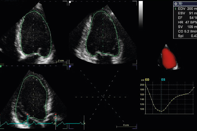 Figure 1  Representation of the volume curve in the entire cardiac cycle (bottom right in image). Volume data and ejection&hellip;
