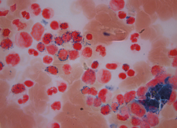 Figure 1  Iron-coloured bone marrow aspirate from the patient shows ringed sideroblasts