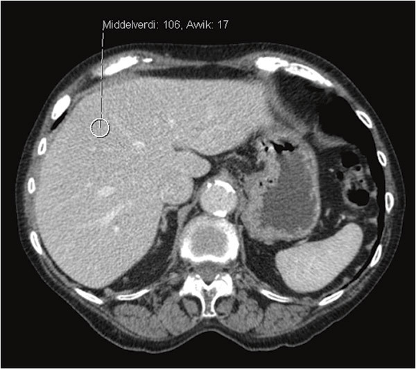 Figure 3  CT abdomen without contrast. The image shows high attenuation in the liver, as with iron accumulation (in contrast&hellip;