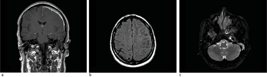 Figure 1  MRI caput: a) T1 sequence with contrast. Swelling of the meninges over the left hemisphere with contrast&hellip;