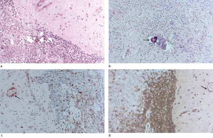 Figure 2  Biopsy of the dura frontally on the left side. Histopathological examination shows thickened dura with fibrosis&hellip;