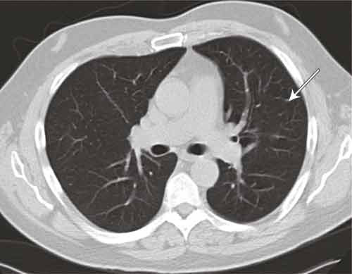 Figure 4  CT thorax. Small, non-specific nodules in left upper lobe