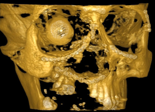 Figure 1  CBCT 3D midface reconstruction