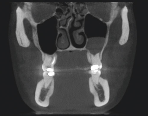 Figure 3  Coronal CBCT sections of the skull with fluid in the sinus maxillaris