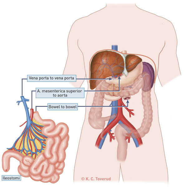 Figure 1   Solated intestinal transplantation with arterial and portal anastomosis in addition to bowel anastomosis and&hellip;
