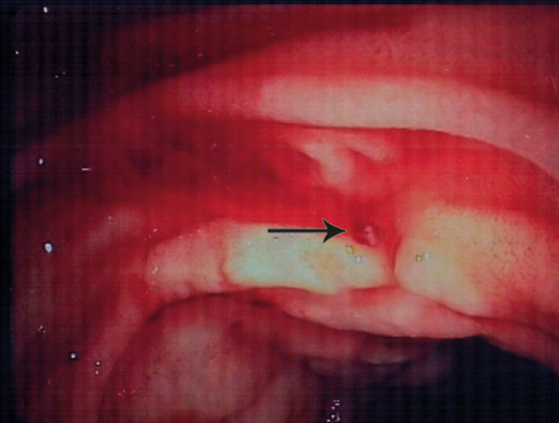 Figure 1  Persistent bleeding from a point (arrow) in the mucous membrane with no visible wound bed
