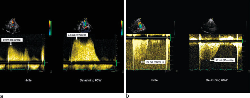 Figure 3:  A young patient with dyspnoea during exercise. Doppler registrations from a) the mitral valve and b) the&hellip;