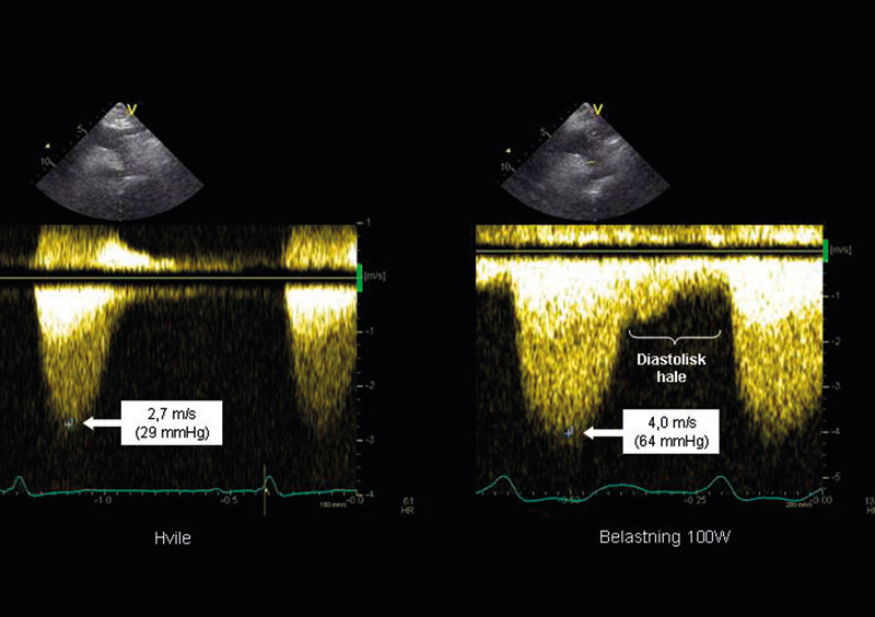 Figure 4:  Echo recordings from a patient referred for a possible recoractation after a previous operation for coarctation&hellip;