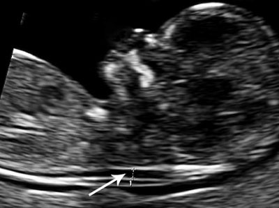 Figure 1:  Ultrasonographic image showing the location for measurement of nuchal translucency (NT) in the fetus. Photo: T. M&hellip;