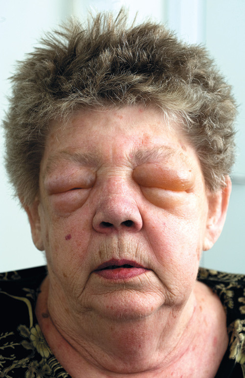 Figure 1  Bilateral, periorbital angioedema induced by treatment with angiotensin converting enzyme inhibitor. The patient&hellip;