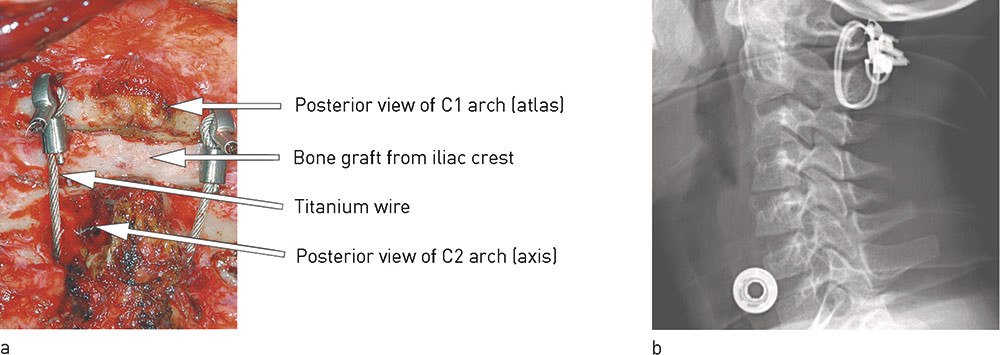 Figure 3  The C1 and C2 arches are fixed to one another with stainless steel or titanium wire bilaterally with a bone graft&hellip;