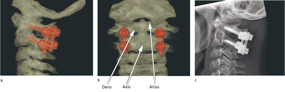 Figure 4  Atlas and axis are fixed with screws and rods bilaterally (Harms technique). CT images from a) the side and b)&hellip;