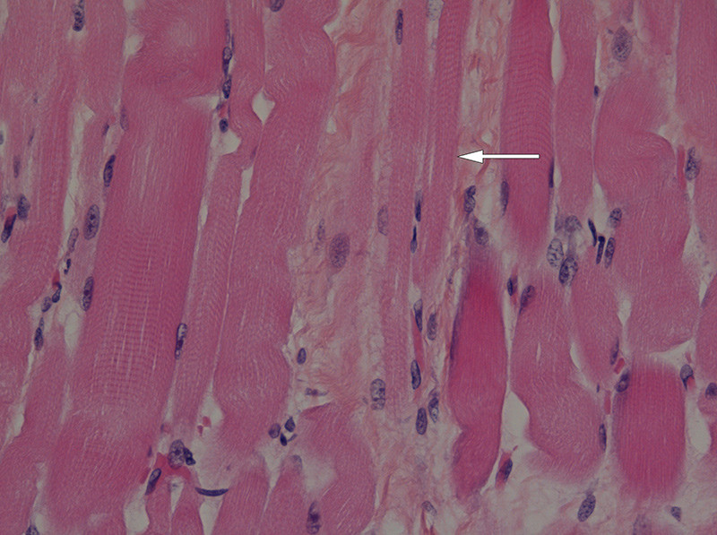 Figure 3  Biopsy of diaphragm showing atrophic muscle fibres (arrow). Photo Christina Vogt