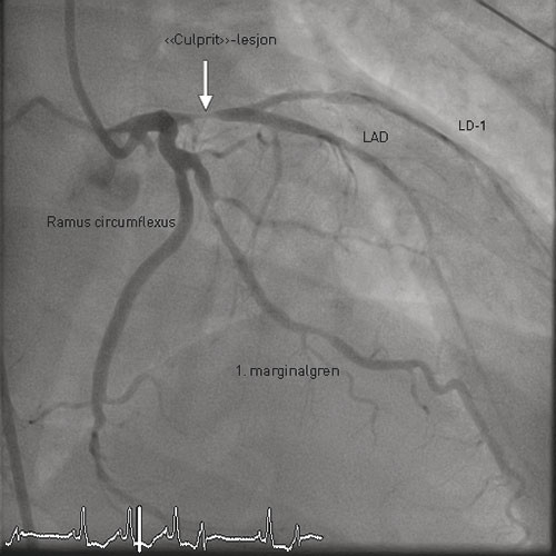 Figure 1  Coronary angiogram showing the left coronary artery. The culprit lesion proximally in the left anterior descending&hellip;