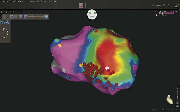 Figure 3  is a three-dimensional electroanatomical model of the left ventricle viewed from the apex. The colours indicate&hellip;