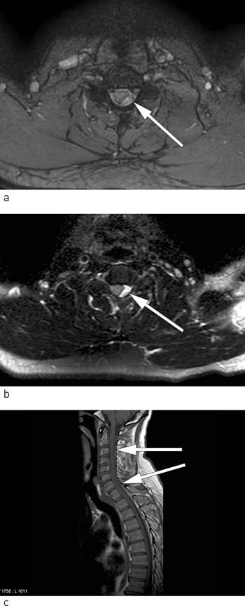 Figure 2  Epidural haematoma with mass effect on different MRI sequences a) and b) axial sections and c) sagittal section,&hellip;